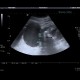 Complicated cyst, Bosniak III: US - Ultrasound